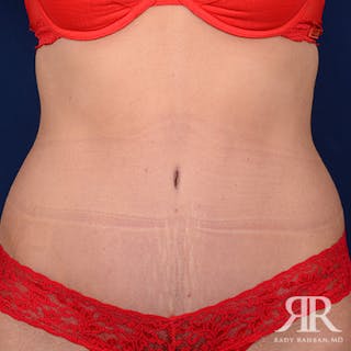Severe Diastasis Recti Before & After Gallery - Patient 677113 - Image 2