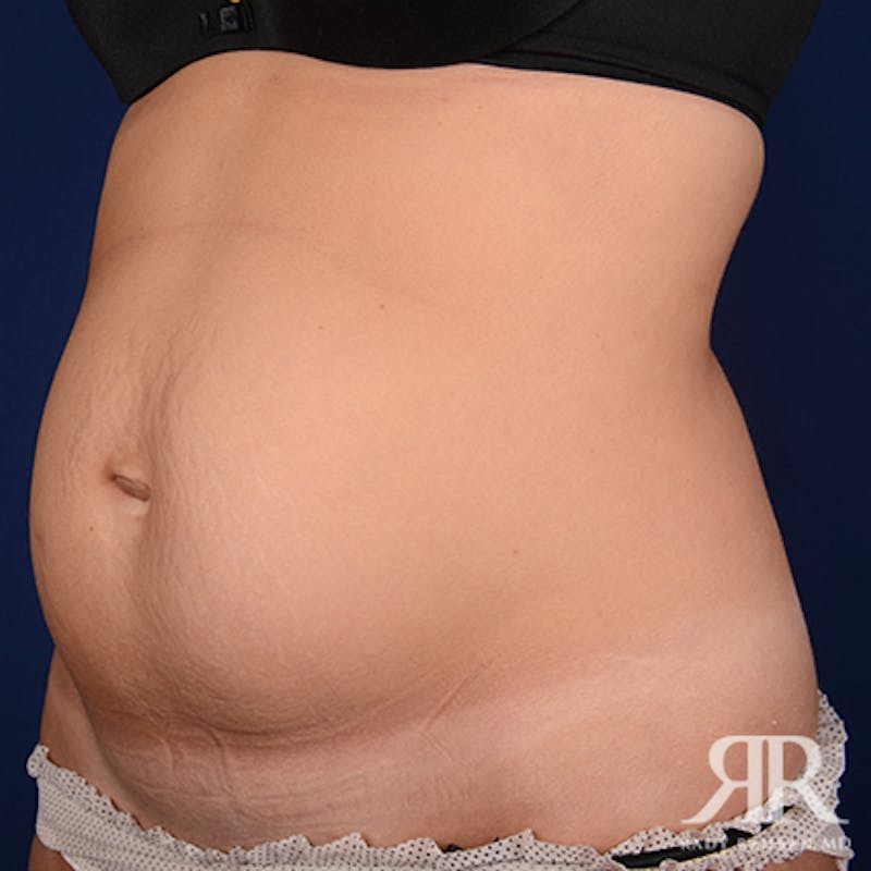 Severe Diastasis Recti Before & After Gallery - Patient 677113 - Image 3