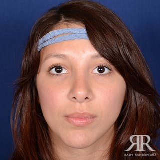 Ethnic Rhinoplasty Before & After Gallery - Patient 165234 - Image 2