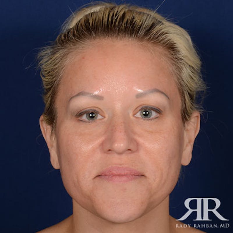 Female Rhinoplasty Before & After Gallery - Patient 583940 - Image 1