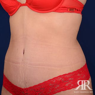 Severe Diastasis Recti Before & After Gallery - Patient 677113 - Image 4