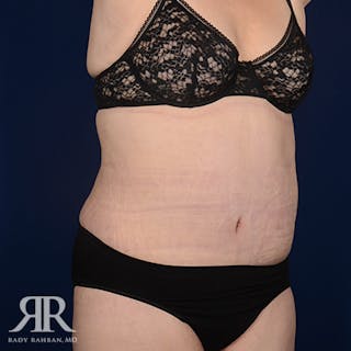 Body Lift Before & After Gallery - Patient 420143 - Image 4