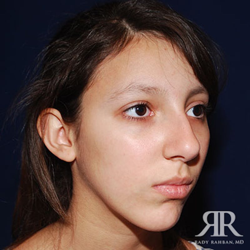 Ethnic Rhinoplasty Before & After Gallery - Patient 165234 - Image 3