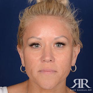 Female Rhinoplasty Before & After Gallery - Patient 583940 - Image 2