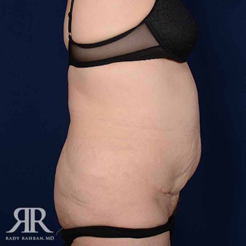 Body Lift Before & After Gallery - Patient 420143 - Image 5