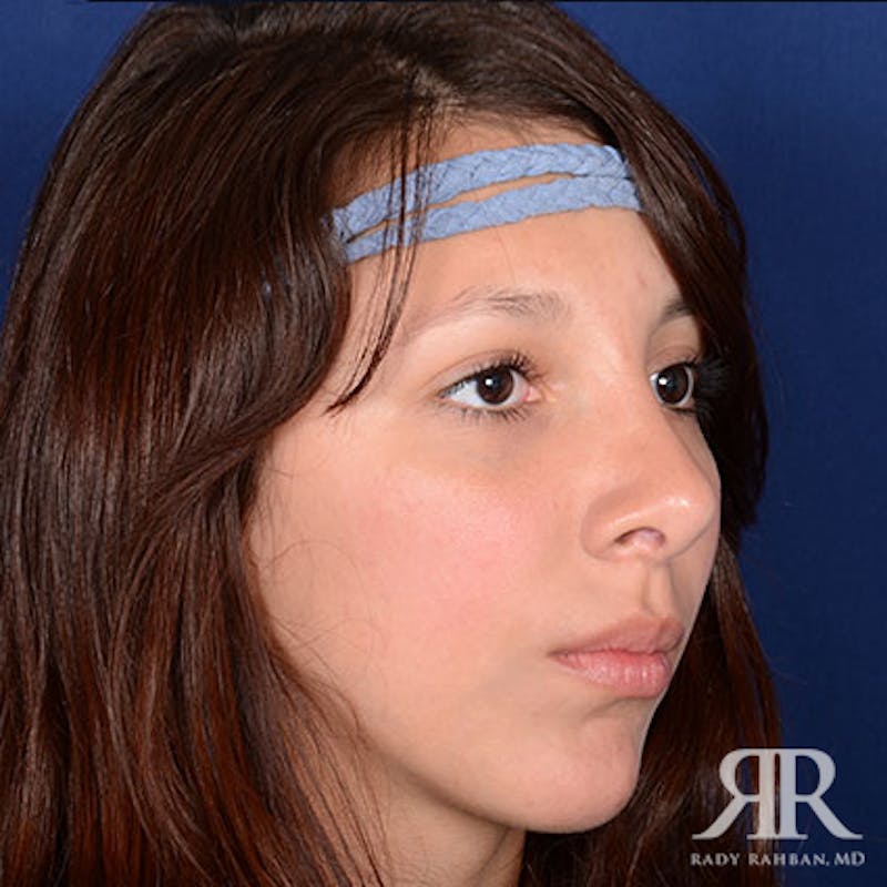 Ethnic Rhinoplasty Before & After Gallery - Patient 165234 - Image 4