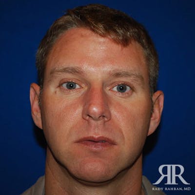Chin Augmentation Before & After Gallery - Patient 269223 - Image 1