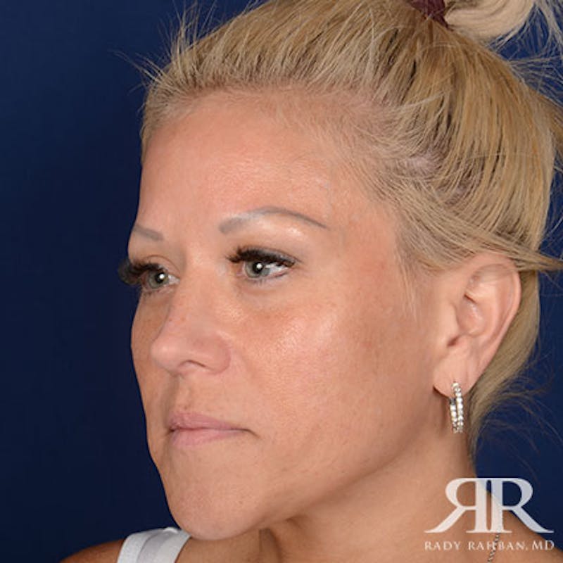 Female Rhinoplasty Before & After Gallery - Patient 583940 - Image 4
