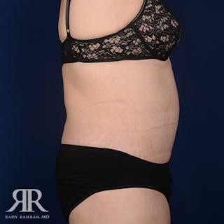 Body Lift Before & After Gallery - Patient 420143 - Image 6