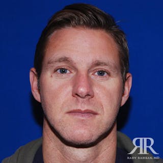 Chin Augmentation Before & After Gallery - Patient 269223 - Image 2