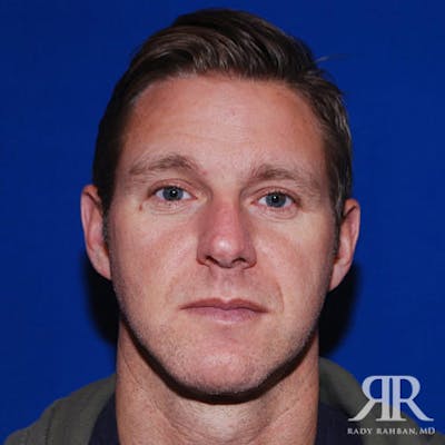 Chin Augmentation Before & After Gallery - Patient 269223 - Image 2