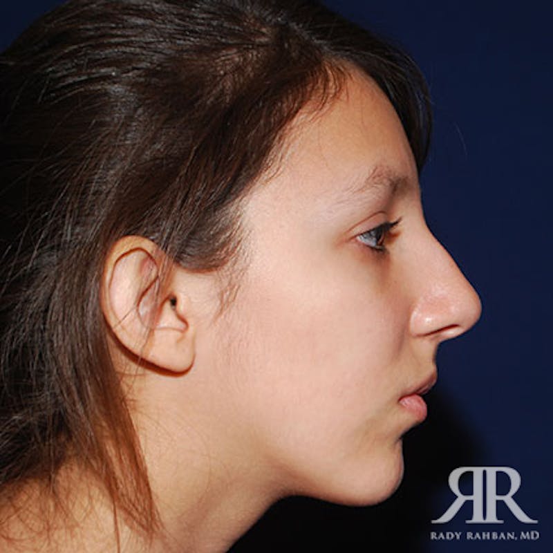 Ethnic Rhinoplasty Before & After Gallery - Patient 165234 - Image 5