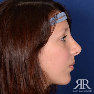 Ethnic Rhinoplasty Before & After Gallery - Patient 165234 - Image 6