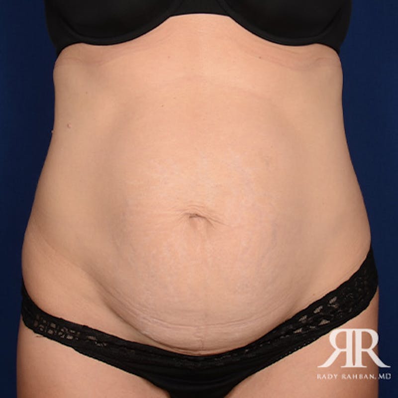 Tummy Tuck Before & After Gallery - Patient 186771 - Image 1