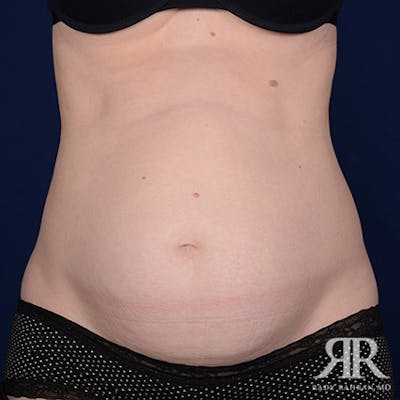 Severe Diastasis Recti Before & After Gallery - Patient 336322 - Image 1