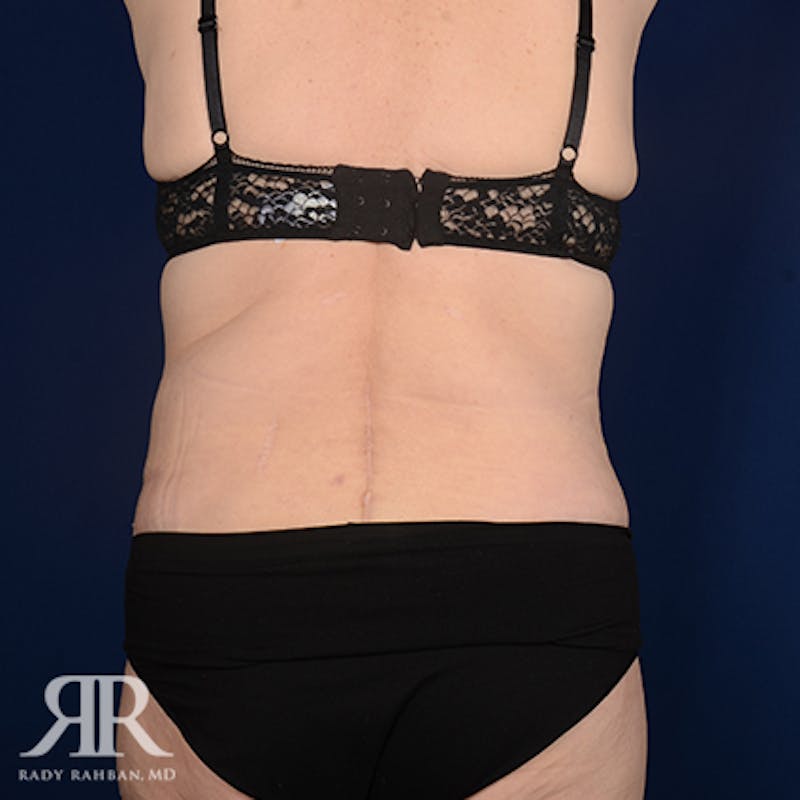 Body Lift Before & After Gallery - Patient 420143 - Image 8