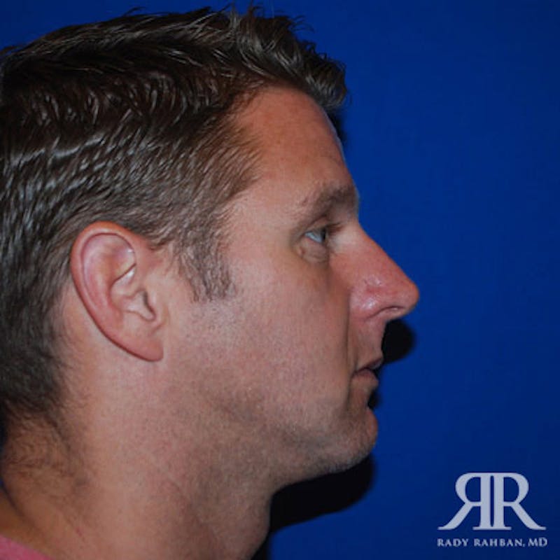 Chin Augmentation Before & After Gallery - Patient 269223 - Image 4