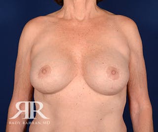 Corrective Breast Surgery Before & After Gallery - Patient 644736 - Image 2