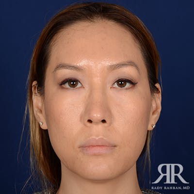 Ethnic Rhinoplasty Before & After Gallery - Patient 107018 - Image 2