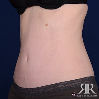 Severe Diastasis Recti Before & After Gallery - Patient 336322 - Image 4