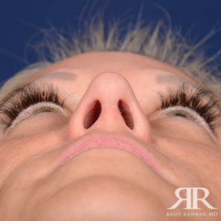 Female Rhinoplasty Before & After Gallery - Patient 583940 - Image 8