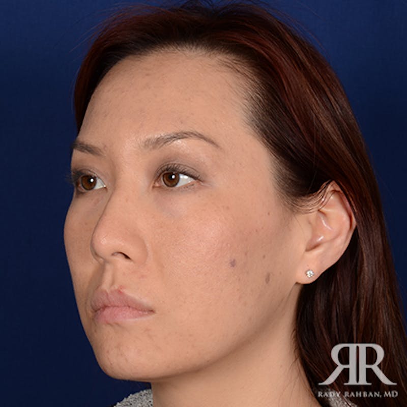 Ethnic Rhinoplasty Before & After Gallery - Patient 107018 - Image 3