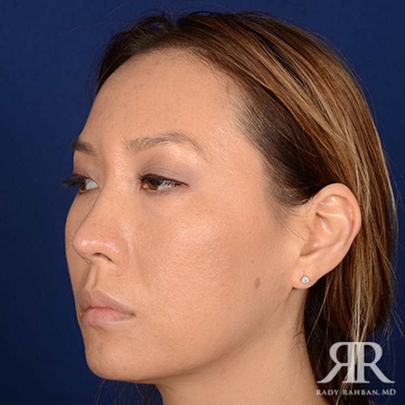 Ethnic Rhinoplasty Before & After Gallery - Patient 107018 - Image 4