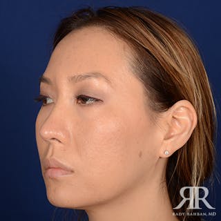 Ethnic Rhinoplasty Before & After Gallery - Patient 107018 - Image 4