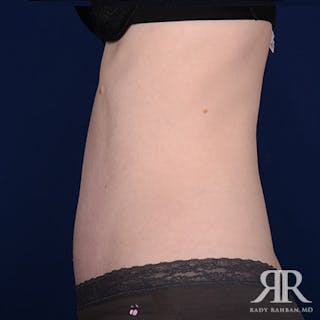 Severe Diastasis Recti Before & After Gallery - Patient 336322 - Image 6
