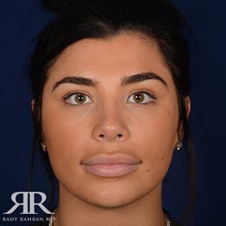Female Rhinoplasty Before & After Gallery - Patient 162908 - Image 2