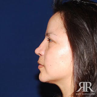 Chin Augmentation Before & After Gallery - Patient 261089 - Image 4