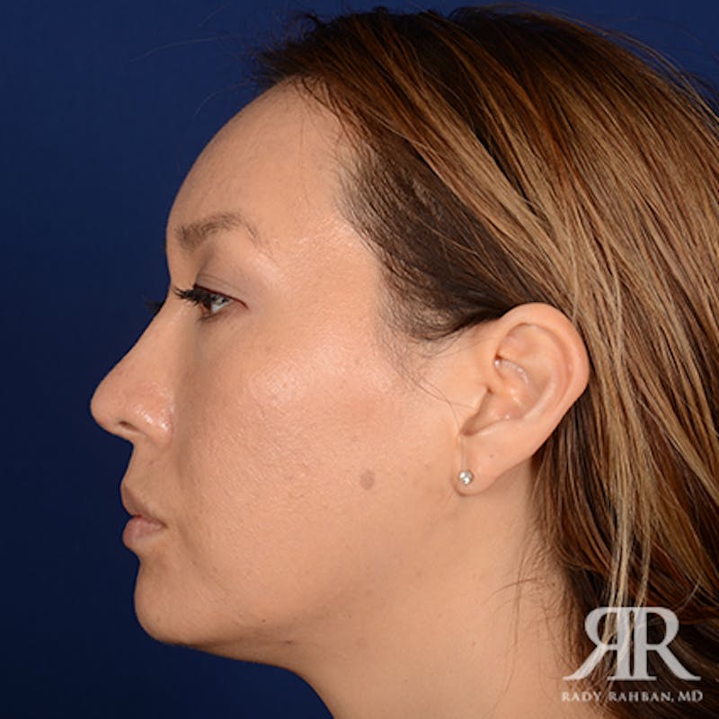 Ethnic Rhinoplasty Before & After Gallery - Patient 107018 - Image 6