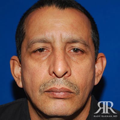 Chin Augmentation Before & After Gallery - Patient 125387 - Image 1
