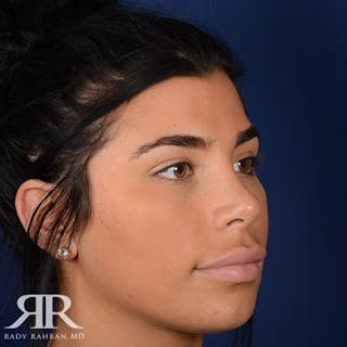 Female Rhinoplasty Before & After Gallery - Patient 162908 - Image 4