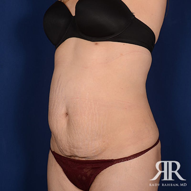 Tummy Tuck Before & After Gallery - Patient 297884 - Image 3