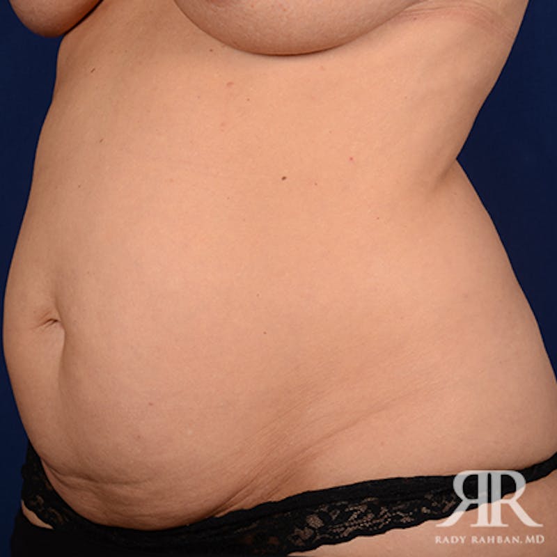 Severe Diastasis Recti Before & After Gallery - Patient 633831 - Image 3