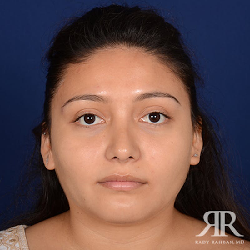 Ethnic Rhinoplasty Before & After Gallery - Patient 281403 - Image 2