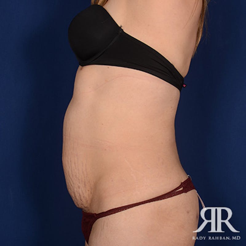 Tummy Tuck Before & After Gallery - Patient 297884 - Image 5