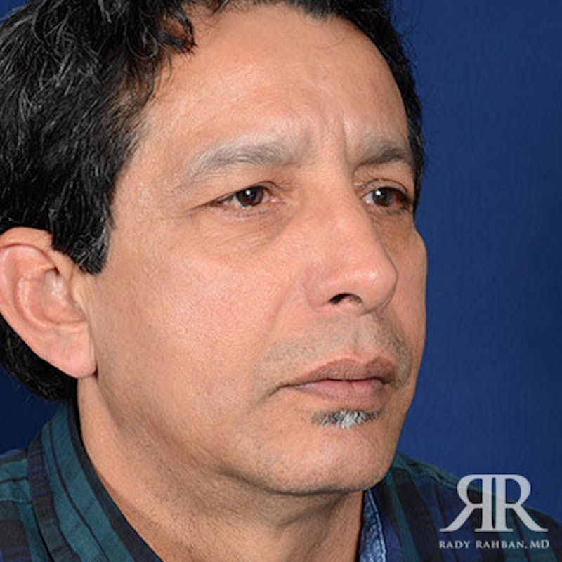 Chin Augmentation Before & After Gallery - Patient 125387 - Image 4