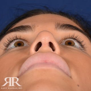 Female Rhinoplasty Before & After Gallery - Patient 162908 - Image 8