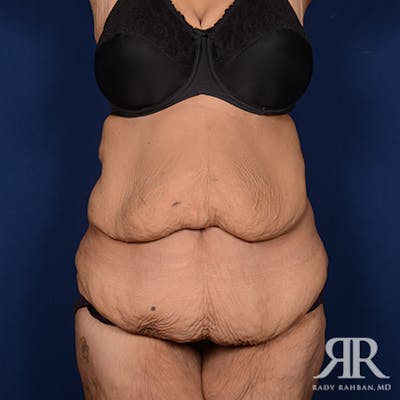 Body Lift Before & After Gallery - Patient 348352 - Image 1