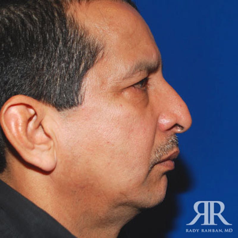 Chin Augmentation Before & After Gallery - Patient 125387 - Image 5