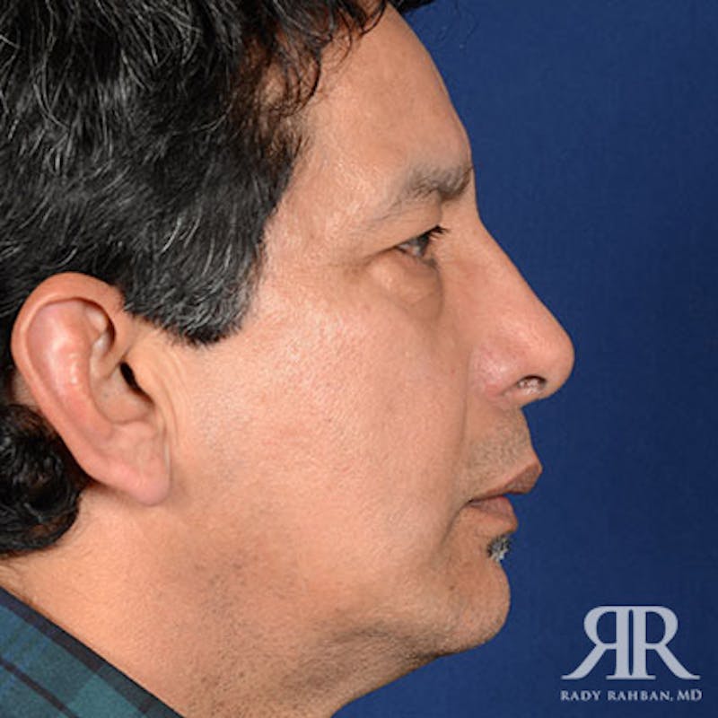 Chin Augmentation Before & After Gallery - Patient 125387 - Image 6