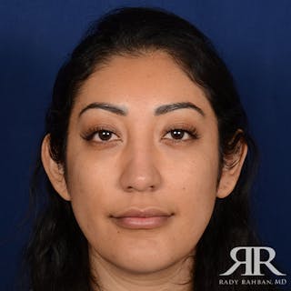 Female Rhinoplasty Before & After Gallery - Patient 123864 - Image 2