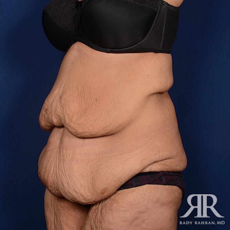 Body Lift Before & After Gallery - Patient 348352 - Image 3