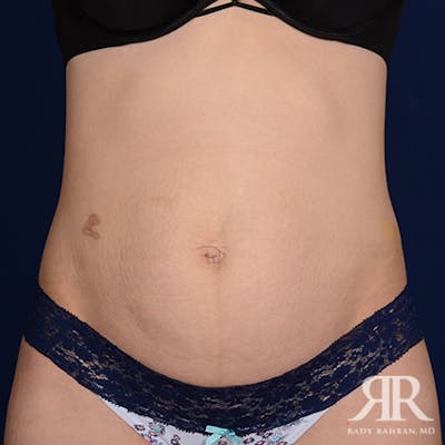 Severe Diastasis Recti Before & After Gallery - Patient 224152 - Image 1