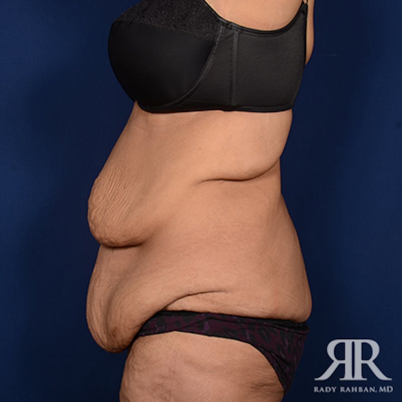 Body Lift Before & After Gallery - Patient 348352 - Image 5