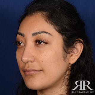 Female Rhinoplasty Before & After Gallery - Patient 123864 - Image 4