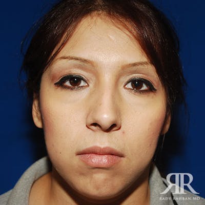 Ethnic Rhinoplasty Before & After Gallery - Patient 336033 - Image 1
