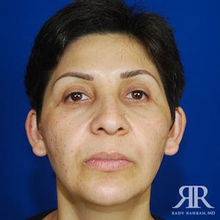 Chin Augmentation Before & After Gallery - Patient 167309 - Image 2